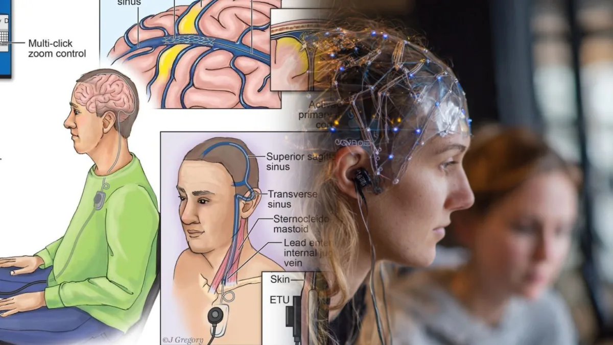 Comunidad BCI de Synchron, Chip Cerebral